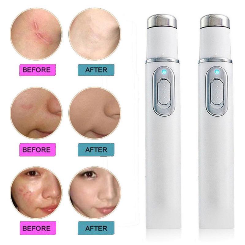 Caneta Blu-ray para remoção de acne, olheiras e bolsas sob os olhos