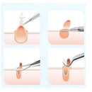 Kit Removedor de Acne Profissional – 4 Peças